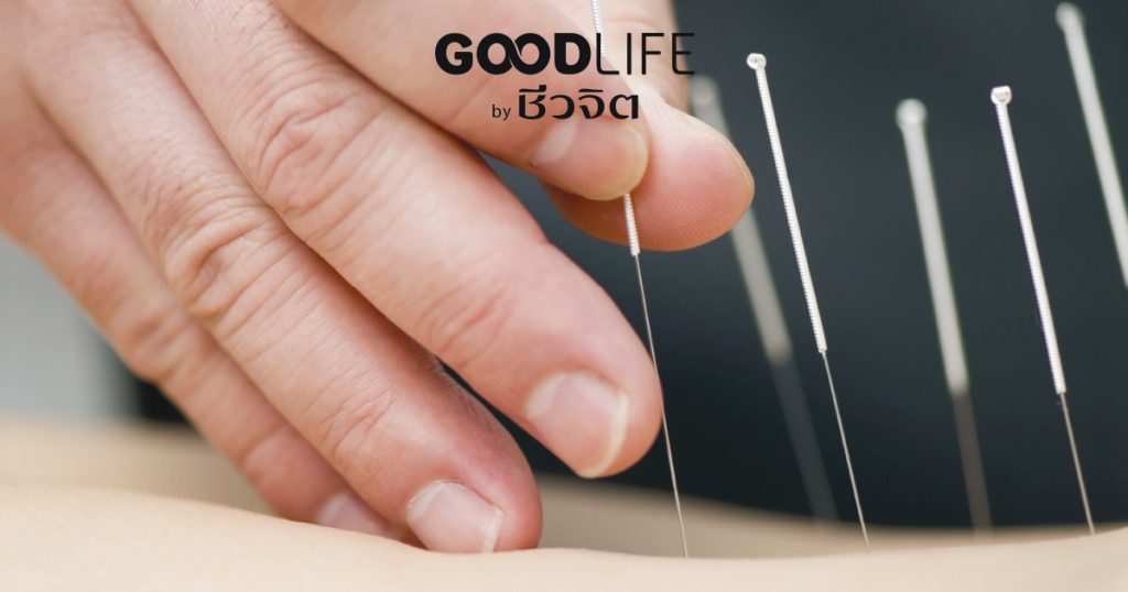 ฝั่งเข็ม, รักษาโรคข้อเข่าเสื่อม, โรคข้อเข่าเสื่อม, อาการข้อเข่าเสื่อม, สาเหตุข้อเข่าเสื่อม