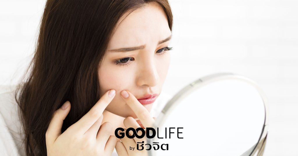 สิว, หยุดสิว, เป็นสิว, สิวประจำเดือน, ประจำเดือน, ปวดประจำเดือน
