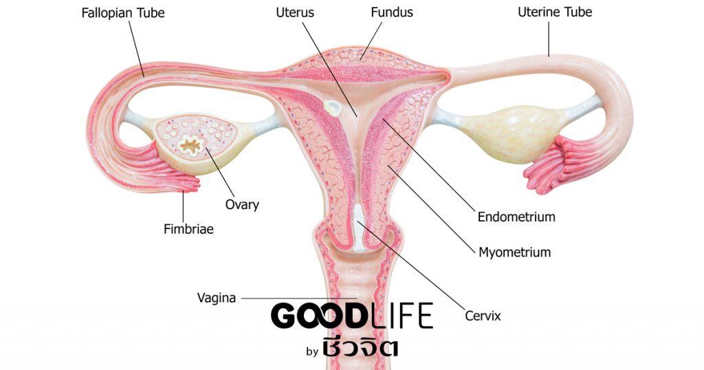 ช็อกโกแลตซีสต์, มดลูก, รังไข่, ซีสต์, มีลูกยาก, เยื่อบุโพรงมดลูกเจริญผิดที่