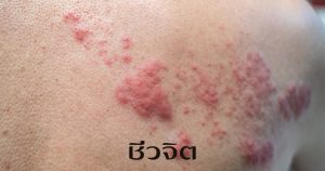 งูสวัด, อาการงูสวัด, โรคงูสวัด, Herpes Zoster, เป็นงูสวัด