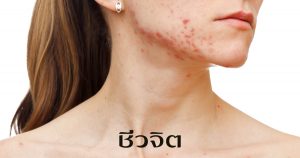 รักษาสิว,สิว