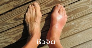 โรคเกาต์