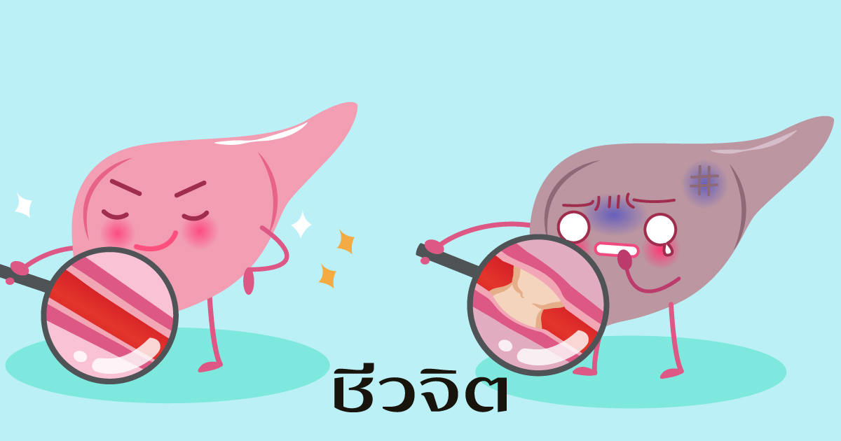 โรคตับ,ไขมันเกาะตับ,มะเร็งตับ,ผู้ป่วยมะเร็งตับ
