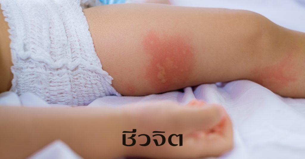 อาการแพ้ในร่างกาย