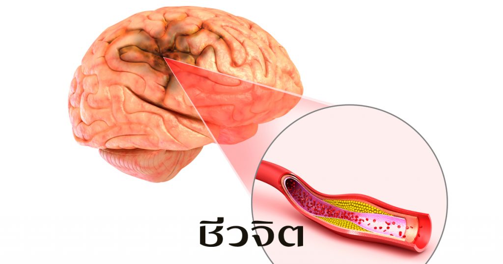 อัมพฤกษ์ – อัมพาต, อัมพฤกษ์, อัมพาต, โรคหลอดเลือดสมอง