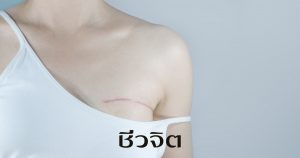 แผลเป็นหลังผ่าตัด แผลเป็น วิธีรักษาแผลเป็น ผ่าตัด 