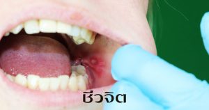 แผลร้อนใน ร้อนใน โรคช่องปาก แผลในปาก ปาก