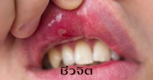 แผลร้อนใน ร้อนใน โรคช่องปาก แผลในปาก ปาก