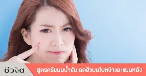 ลดสิว สิว สิวบนใบหน้า สิวบนแผ่นหลัง