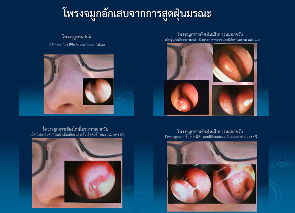 ฝุ่นพิษมรณะ PM2.5