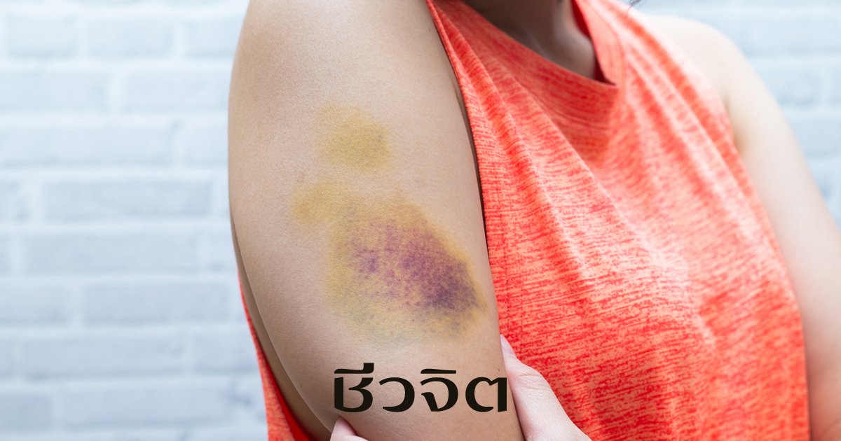 รอยช้ำตามตัว