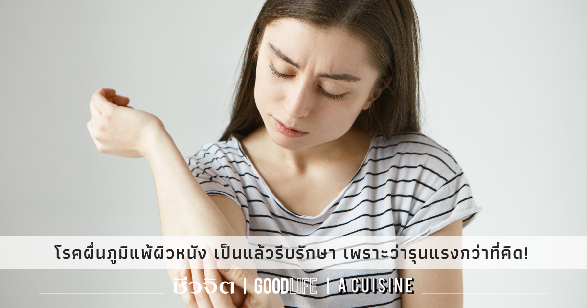 โรคผิวหนัง-ผื่นภูมิแพ้ผิวหนัง
