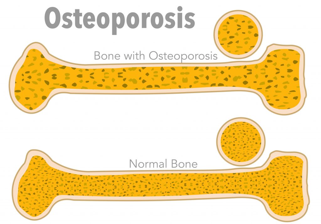 โรคกระดูกพรุน