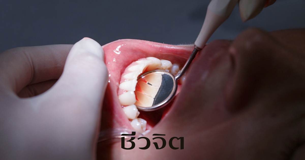การป้องกันโรคเหงือกอักเสบ 