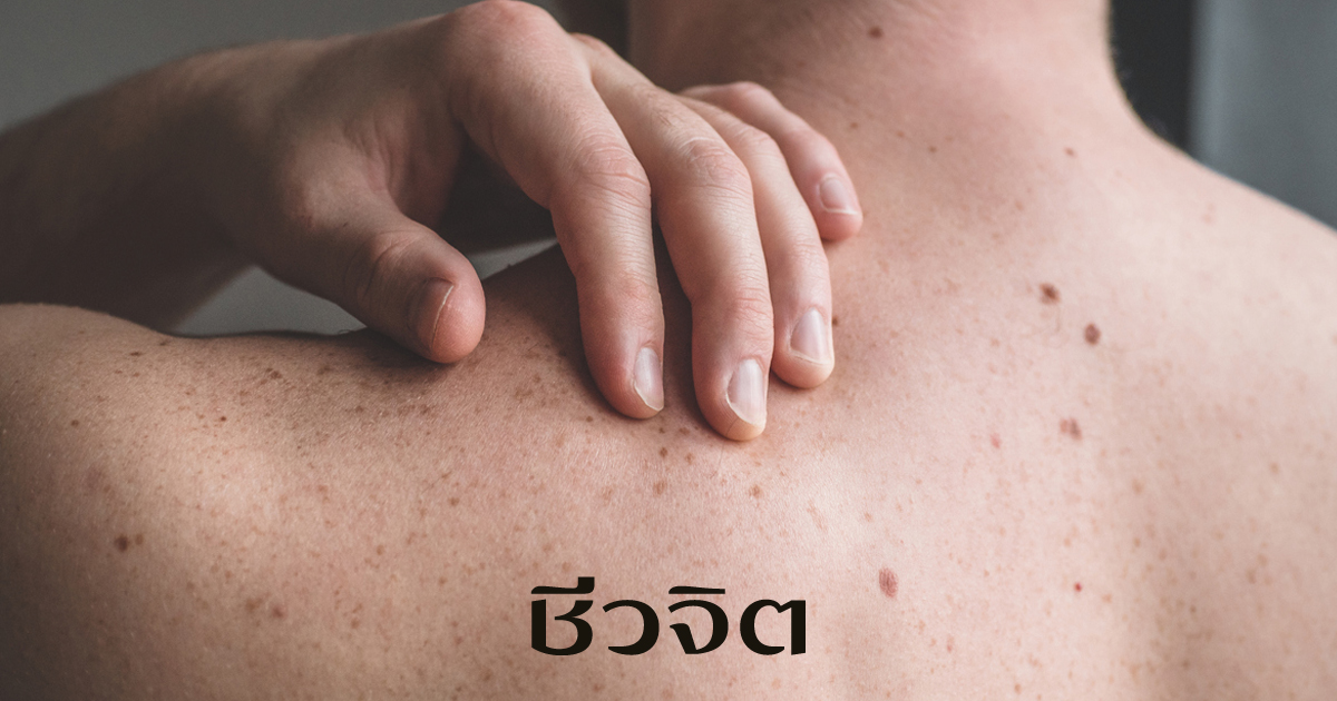 มะเร็งผิวหนัง