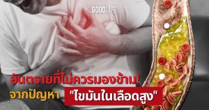 ไขมันในเลือดสูง นัตโตะ ลดคอเลสเตอรอล